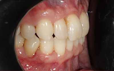 Healthy perfectly aligned smile after Invisalign treatment