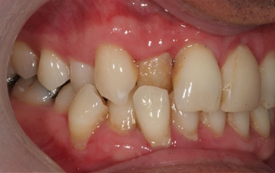 Crooked teeth and misaligned bite before Invisalign treatment