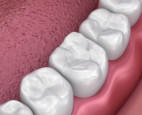 Animated smile with dental sealants in place