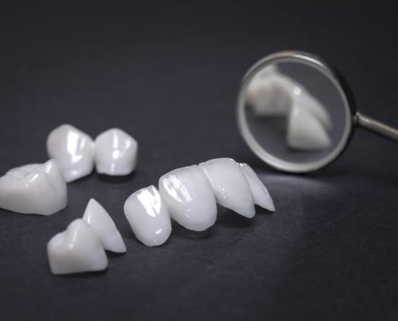 Porcelain veneer options prior to placement