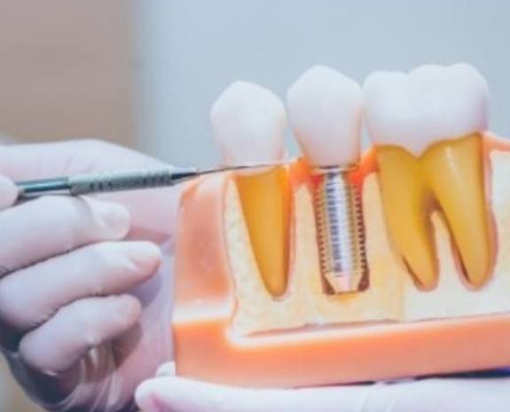 Dentist using model smile to explain the dental implant process
