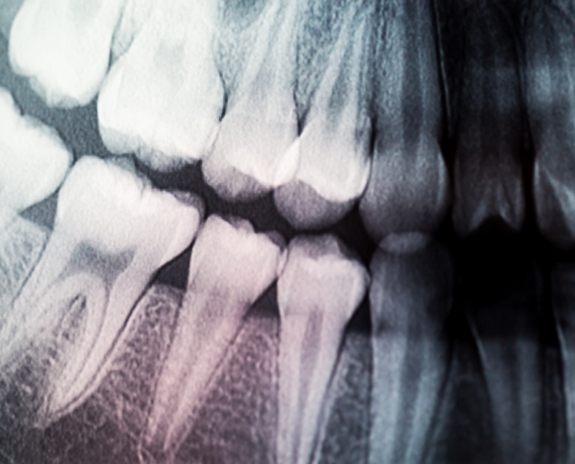 Closeup of digital dental x-rays