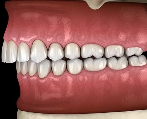 Animated smile in need of occlusal splint treatment